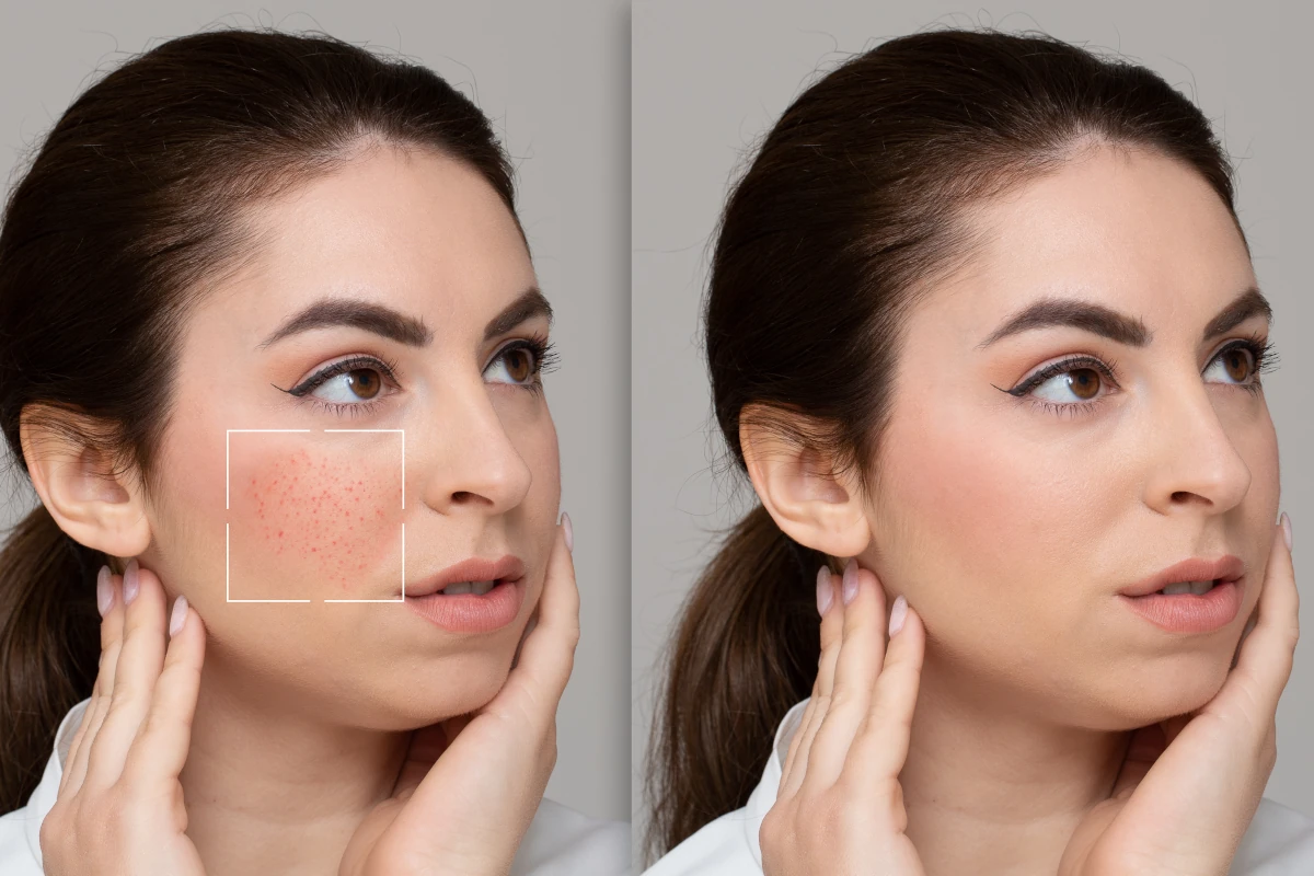dwa zdjęcia twarzy tej samej kobiety z porównaniem stanu skóry