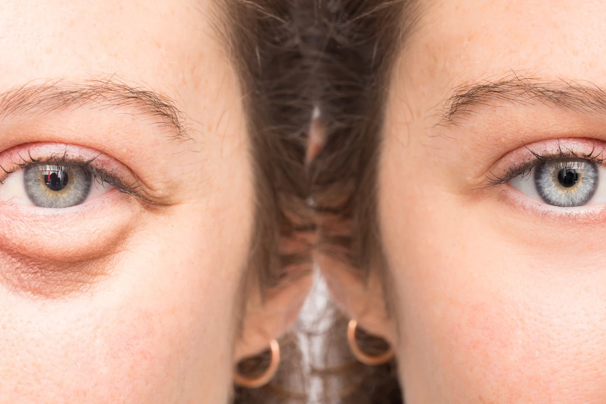 kobieta przed i po usunięciu podkrążonych oczu